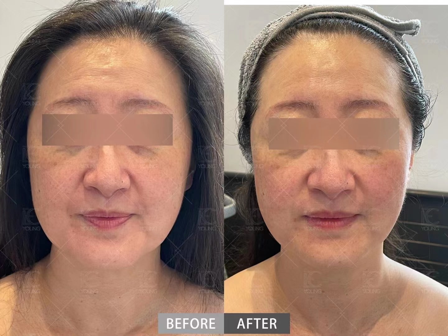 A comparison of patient before and after the thermage, her chin and cheek is uplifting after treatment