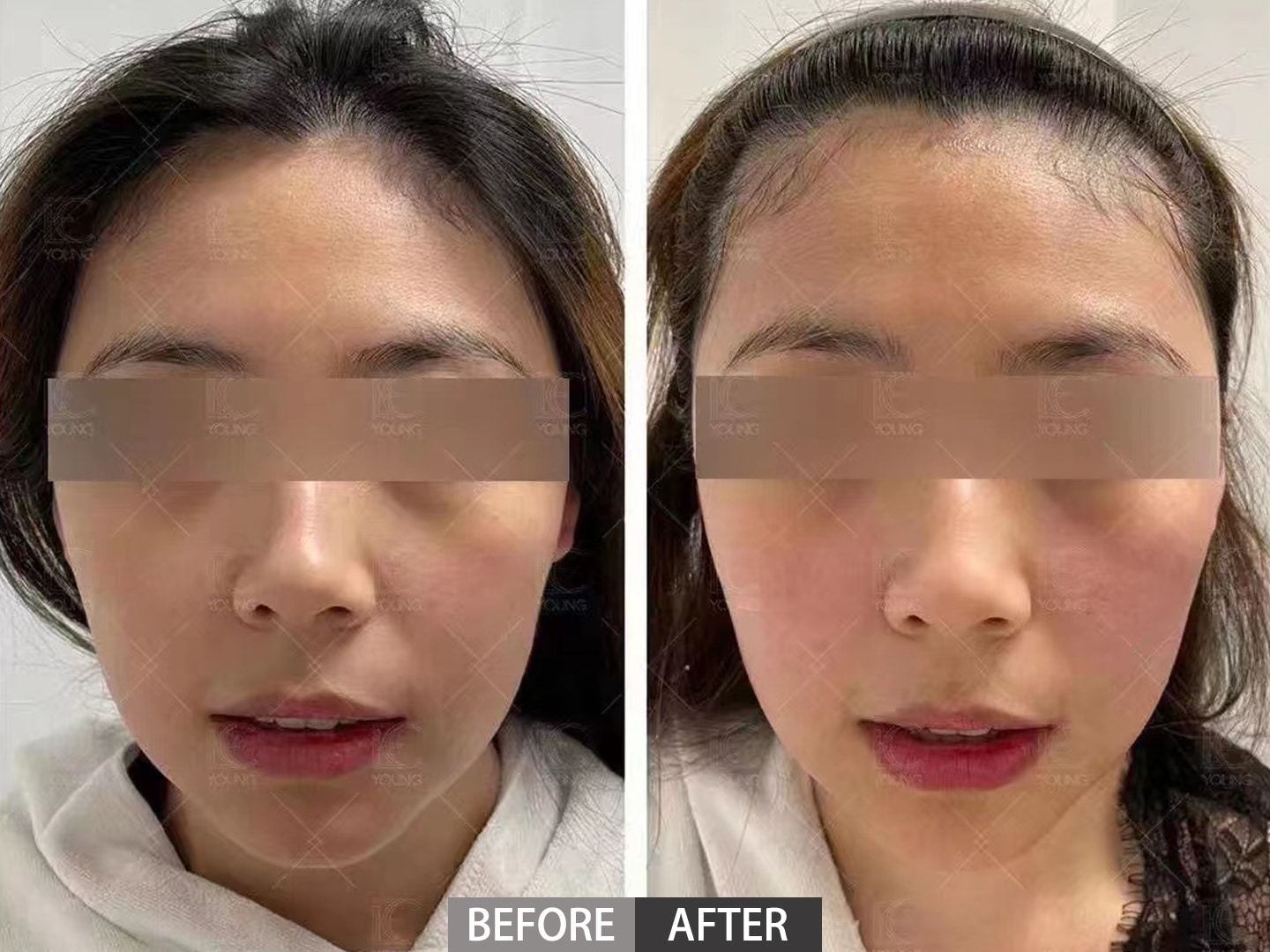 A comparison of patient before and after the thermage,her cheek is uplifting after treatment