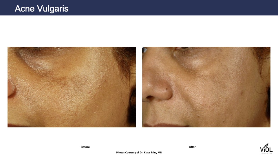 Acne 1