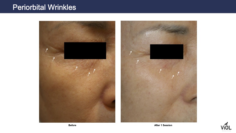 Wrinkles 2