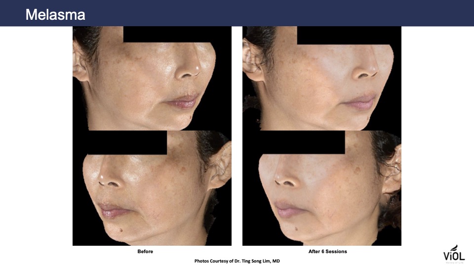 melasma 4